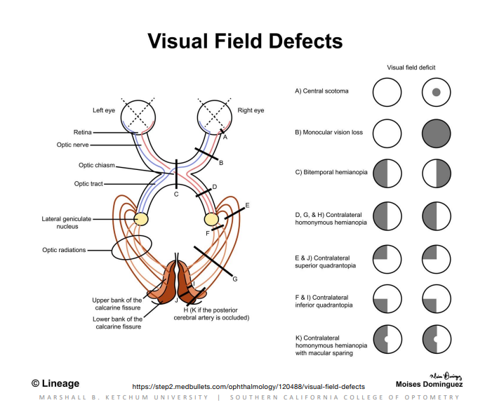 <p>Visual Field Defects</p>