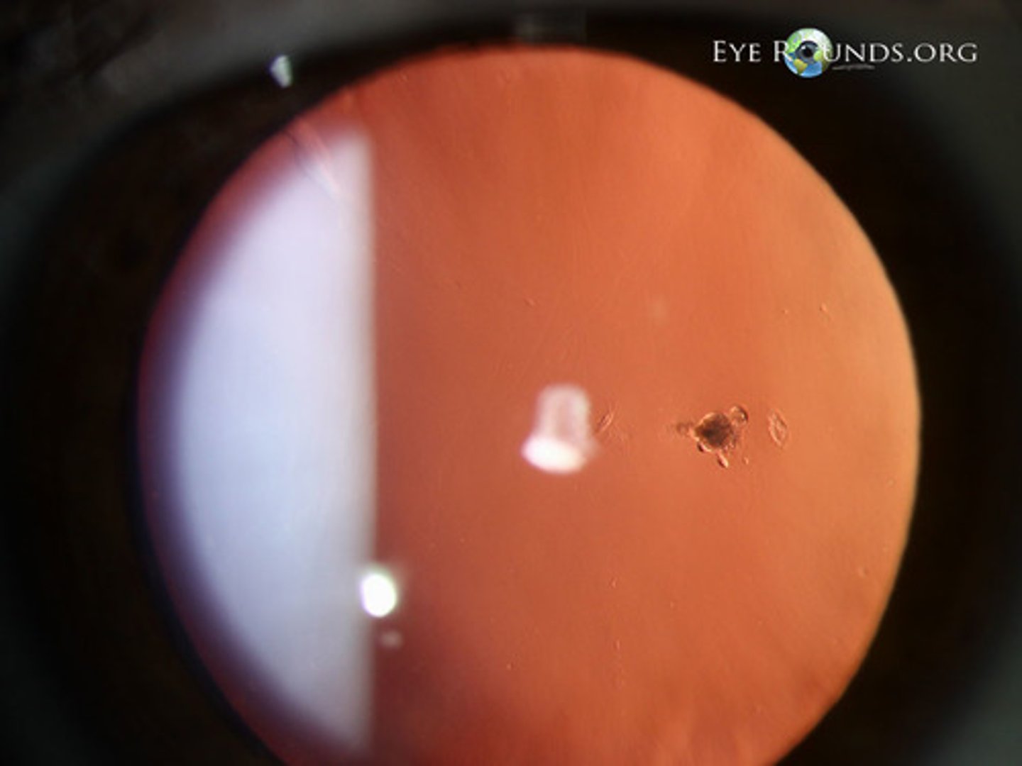 <p>small circular opacity on posterior capsule of lens (anterior attachment)</p>
