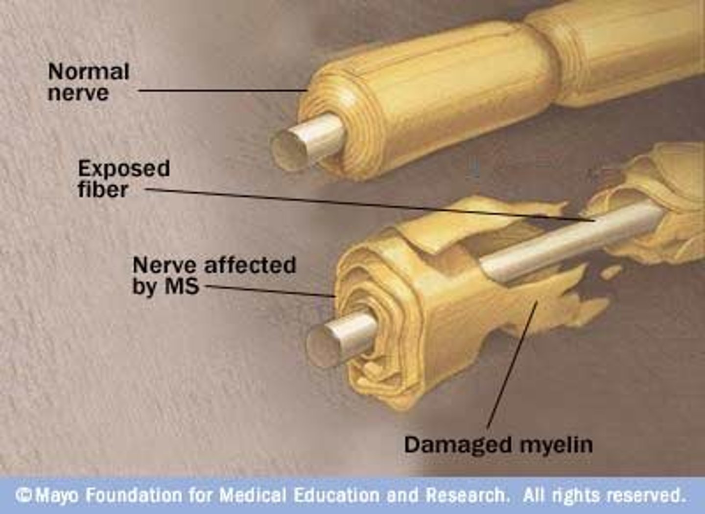 <p>myelin sheath destroyed, scar tissue blocks nerve path - virus can trigger</p>