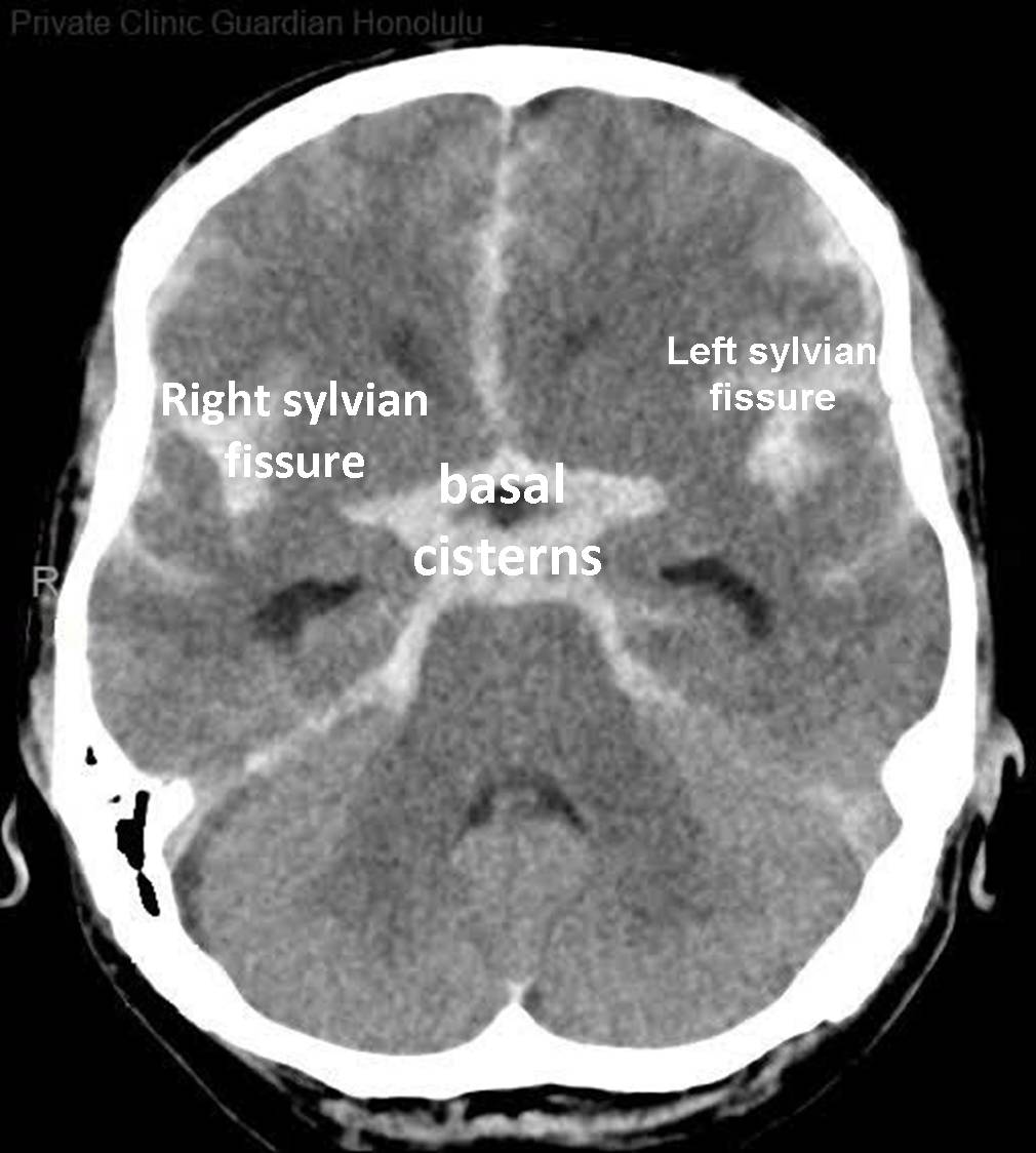 <ul><li><p>‘Dancing man’ around circle of willis</p></li><li><p>Hyperdense in basal cistern, lateral fissues, L and R sylvian cistern</p></li></ul><p></p>