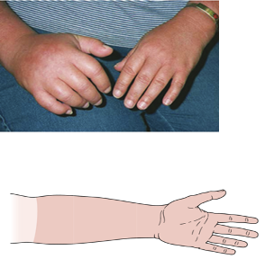 <p>Symptoms follow a glove or stocking pattern </p>