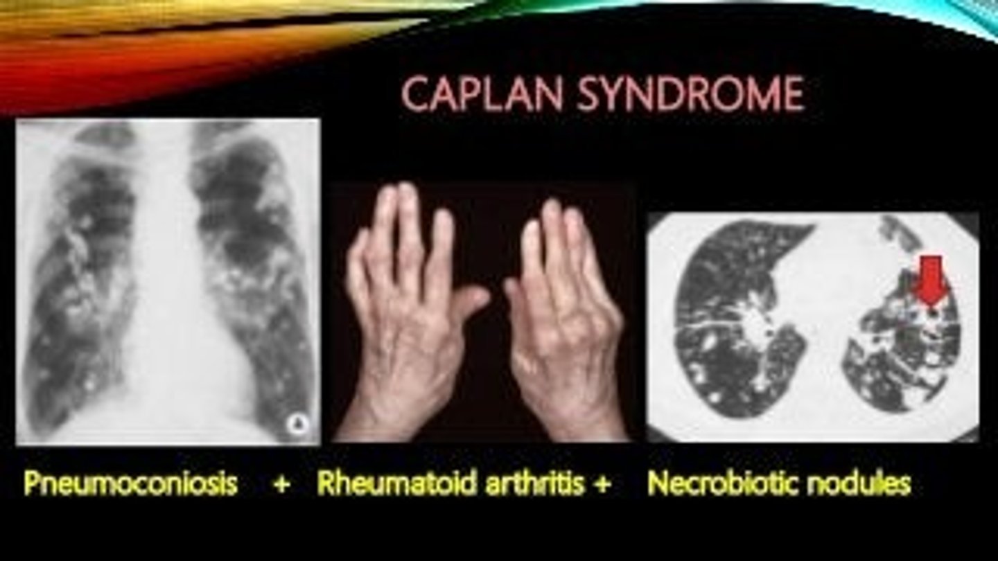 <p>Coal-workers lung + rheumatoid lung nodules/rheumatoid arthritis (possible complication of CWL)</p>