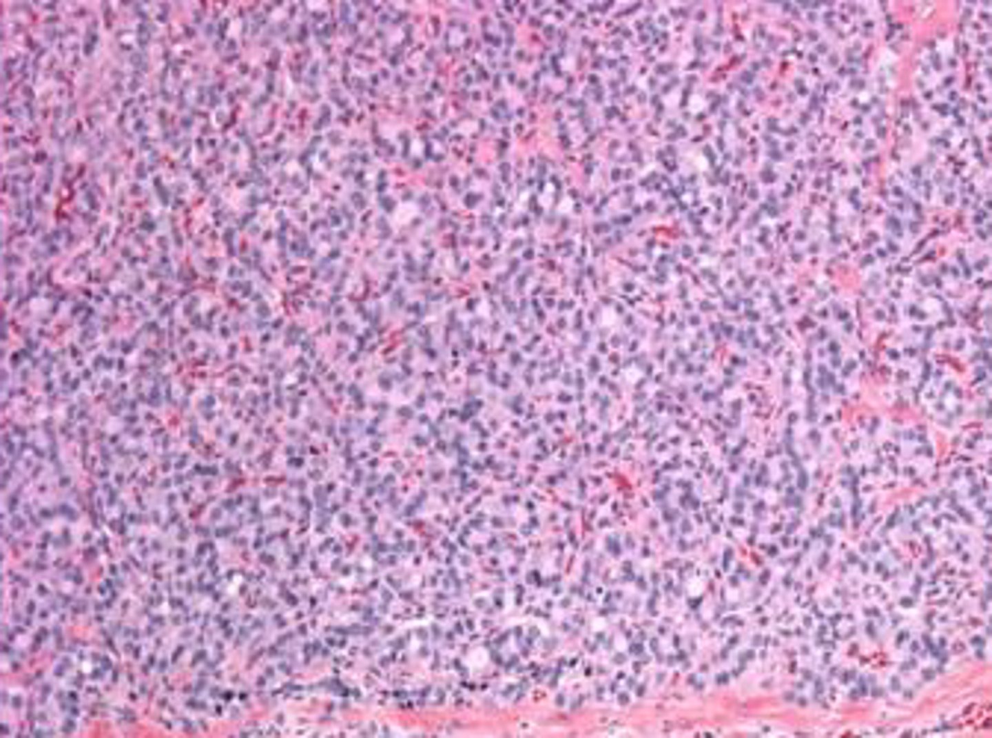 <p>follilcular adenoma composed of solid sheets</p>