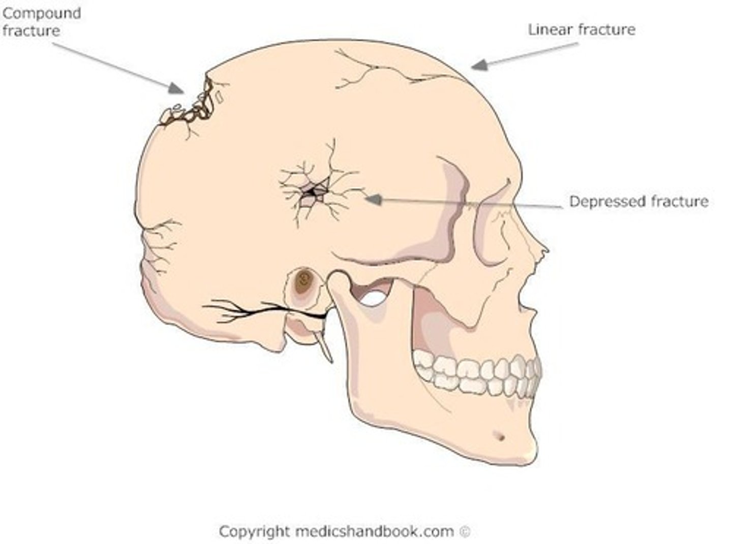 <p>Inward indentation of skull from high-impact injury.</p>