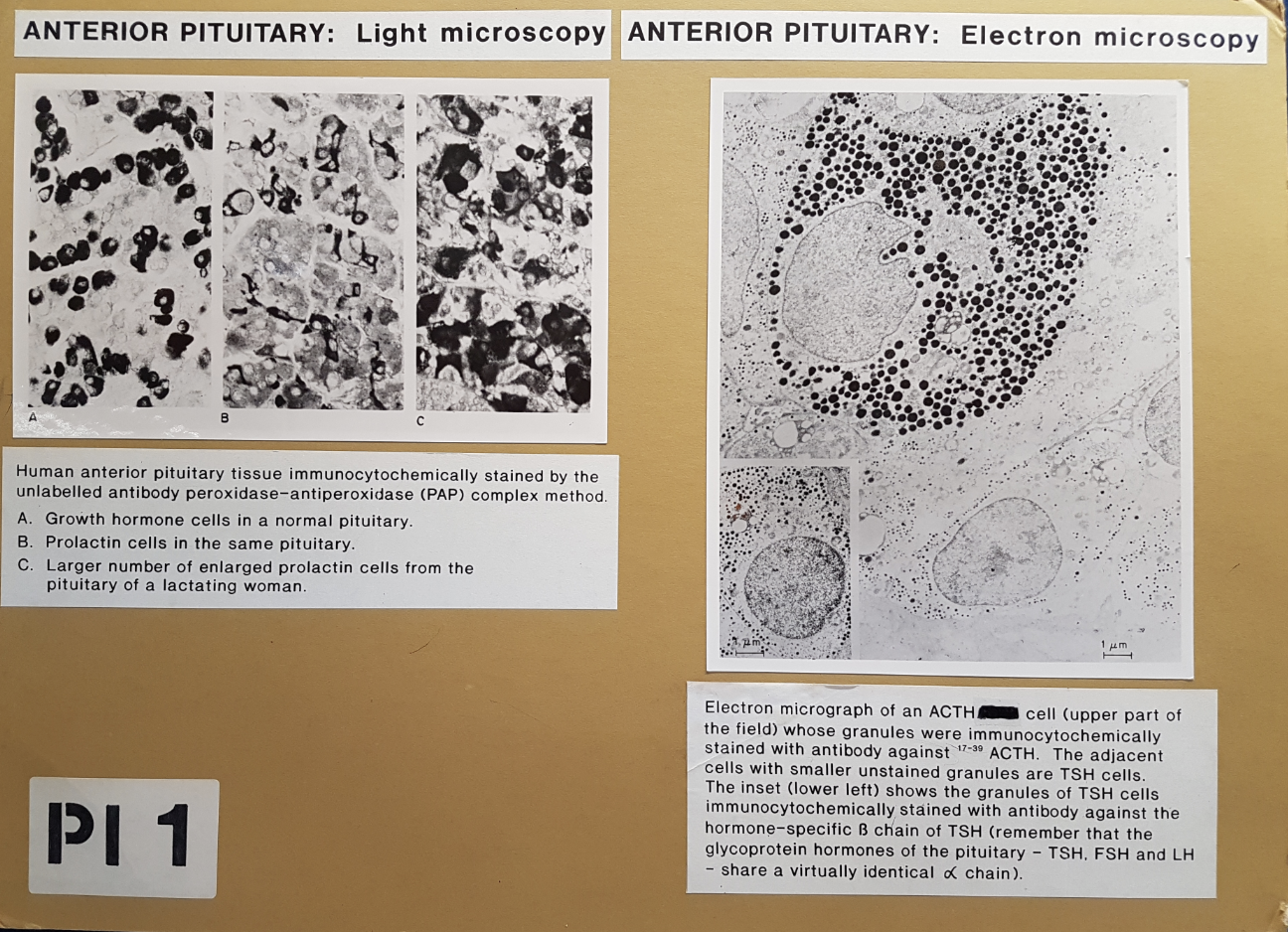 <ul><li><p> stained with immunocytochemically</p><ul><li><p>LM→ growth hormone cella and prolactin cells</p><ul><li><p>enlarged prolactin cells in lactating women</p></li></ul></li><li><p>EM-. ACTH and TSH cells</p></li></ul></li></ul><p></p>