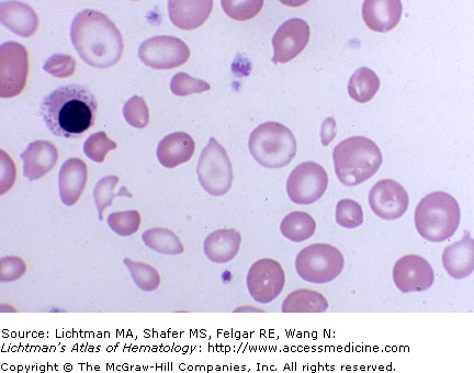Resultados de laboratorio por beta-talasemia mayor 