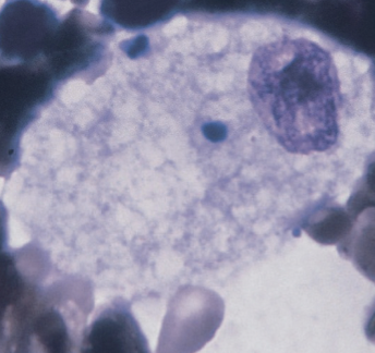 <p>Lipid buildup in macrophages; BM contains macrophages that contain <strong><u>foamy cytoplasm</u></strong> packed with lipid-filled lysosomes that appear as vacuoles after staining</p>