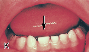 <ul><li><p>union of two adjacent tooth germs, possibly resulting from pressure in the area</p></li><li><p>a different head and root, but are joined together</p></li><li><p>Two tooth buds merge as a result of pressure</p></li><li><p>fewer teeth in the arch</p></li></ul><p></p>