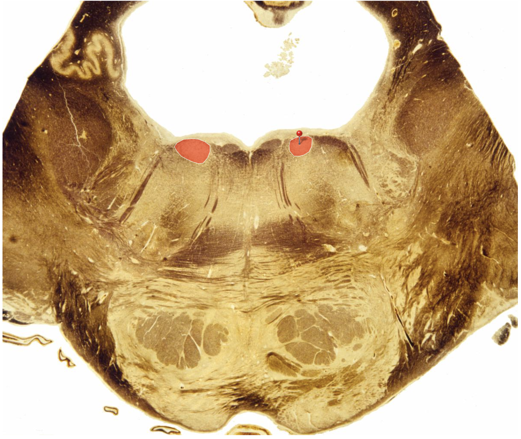 <p>Abducens Nucleus</p><p></p><p>Supplies Lateral Rectus</p>