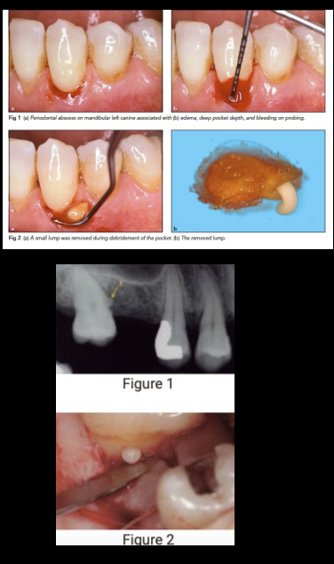 <p>Perio: can be acute exacerbation or after treatment</p><p>N-Perio: due to harmful habits, ortho, impaction, alteration of root surface, perforation, enamel pearl, fissure/fracture</p>