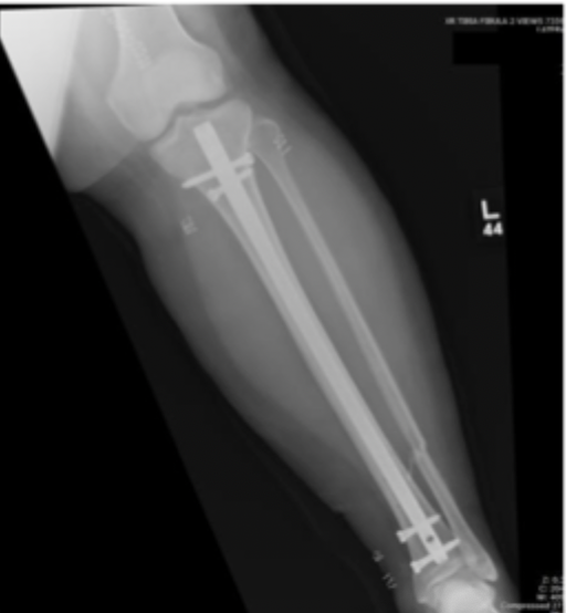 <p>immediate fracture reduction, splint (lower extremity spint/AO), <strong><u>IMN </u></strong>maybe with external fixation first if open</p>