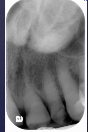 <ol><li><p>dense radiopaque shadow attached to the hard palate</p></li><li><p>well-defined periphery, may have convex or lobulated outline</p></li><li><p>maybe superimposed over roots of teeth</p></li></ol><p></p>
