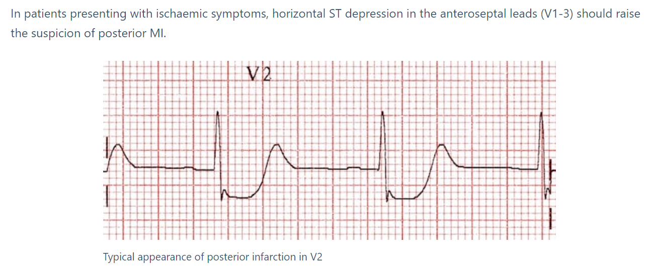 <p>False - ST depression in leads V1-V3 may indicate <strong>posterior wall MI</strong><br></p>