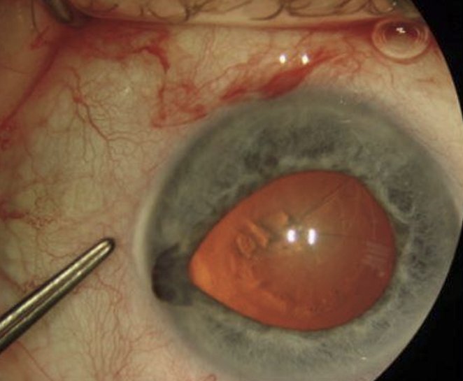 <ul><li><p>Tx of Benign Prostatic Hypertrophy (BPH) </p></li><li><p>Helps maintain regular urinary flow by antagonizing alpha adreneric receptors to relax smooth muscles on urinary sphinceter. </p></li><li><p>Causes Floppy iris syndrom by blocking alpha receptors on iris dilator, preventing full pupillary dilation. </p></li><li><p>Causes complications during cataract surgery </p></li></ul><p></p>