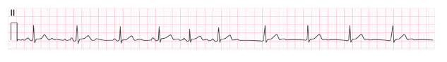 <p><span><span>Which rhythm is on the strip?</span></span></p>
