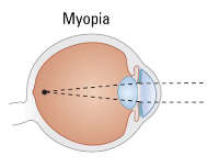 <p>aka. Nearsightedness</p><p>People cannot bring <u>distant</u> objects into clear focus, because the focal point of light falls <em>short</em> of the retina.</p><ul><li><p>Most commonly caused by the normally round eyeball being elongated → eyeball is too long. Can also be caused by excessive curvature of the front of the cornea.</p></li></ul><p></p>