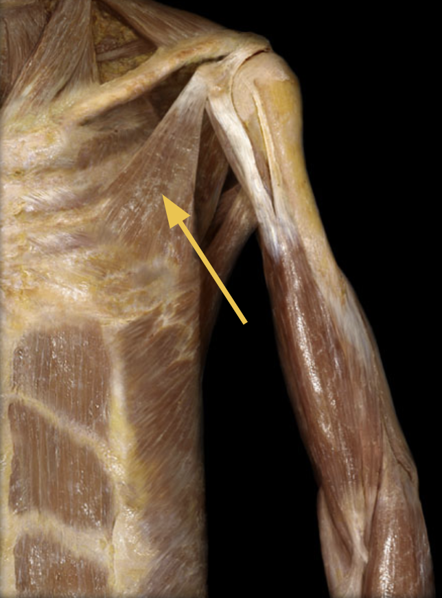 <p>pectoralis minor m.</p><p>O: Anterior surface of ribs 3-5 <br><br>I: Coracoid process of scapula <br><br>A: scapular abduction, downward rotation of the scapula, depression of scapula <br><br>Inn: Medial pectoral n., Lateral pectoral n.</p>