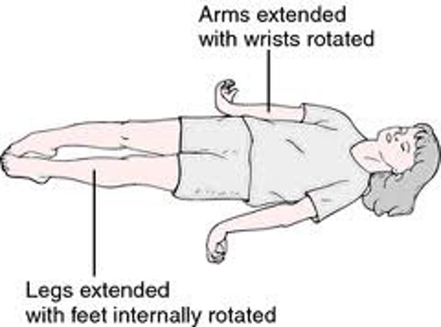<p>-"extensor posturing";</p><p>-abduction of arms, elbow and wrist extension and extension and PF of legs</p><p>Think decerebrate has a lot of e's for extension of all extremities</p>