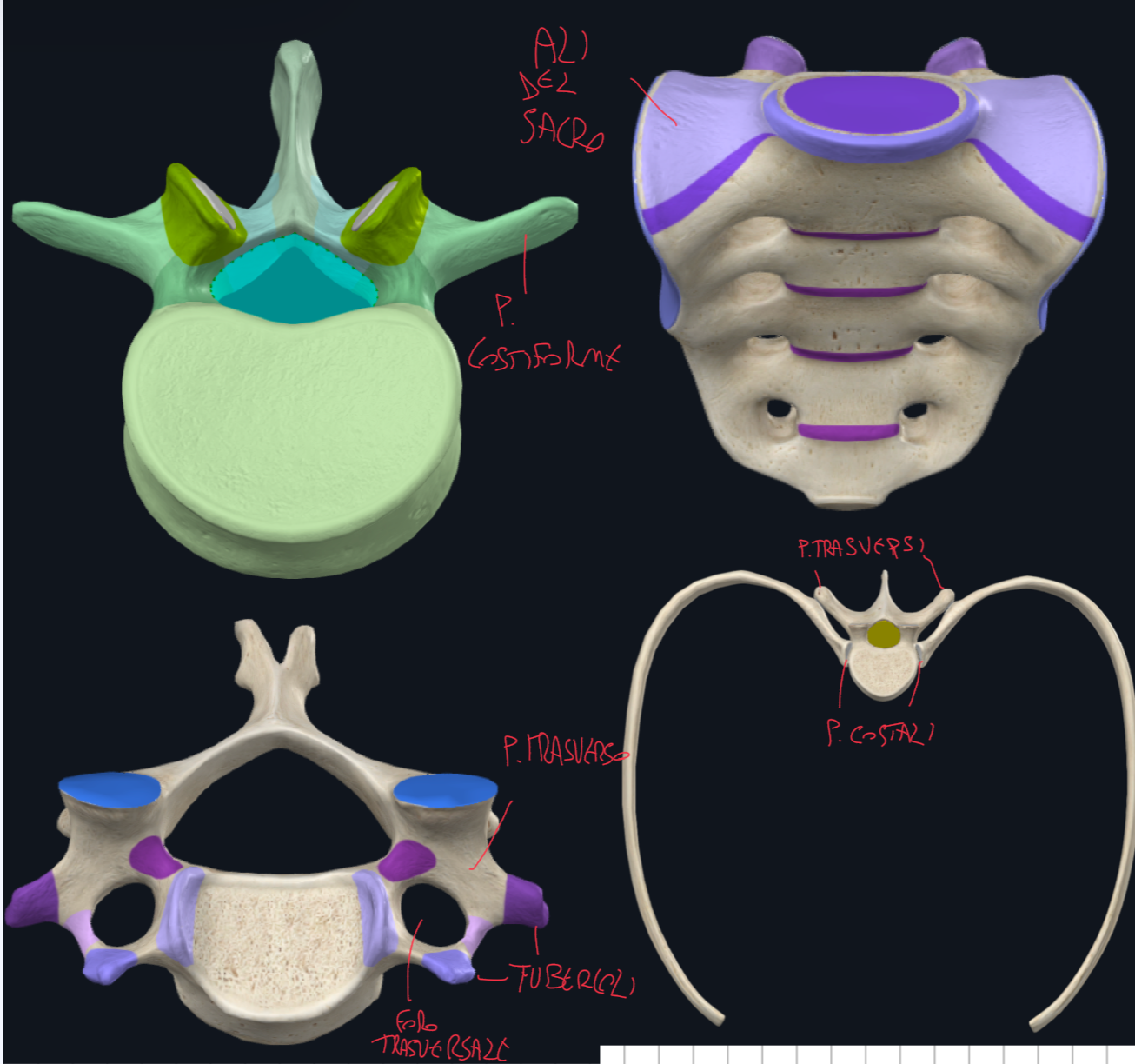<p>Tutte le vertebre durante lo sviluppo presentano processi costali separati da quelli trasversi:</p><ul><li><p>Nelle vertebre toraciche continuano a svilupparsi e formano le coste che si articolano sia con corpo che processo trasverso della vertebra</p></li><li><p>Nella vertebre cervicali il processo costale si fonde parzialmente con il processo trasverso ed evidenzieremo fori trasversali e tubercoli anteriore e posteriore</p></li><li><p>Nelle vertebre lombari il processo costale si fonde completamente con il trasverso costituendo la maggior parte → per questo si chiama processo costiforme</p></li><li><p>Nelle vertebre sacrali i processi costali di fondono tra loro e con le vertebre adiacenti, formando le ali del sacro.</p></li></ul><p></p>