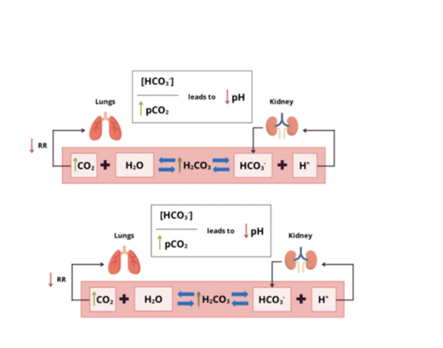 <p>pathology:</p><p>- due to failure of ventilation → accumulation of CO2 in blood</p><p>- primary disturbance: ↑ pCO2 => ↓ HCO3:pCO2 ratio = ↓ pH</p><p>Compensation:</p><p>- kidneys excrete more H+ (and NH4+) and reabsorb more HCO3-</p>