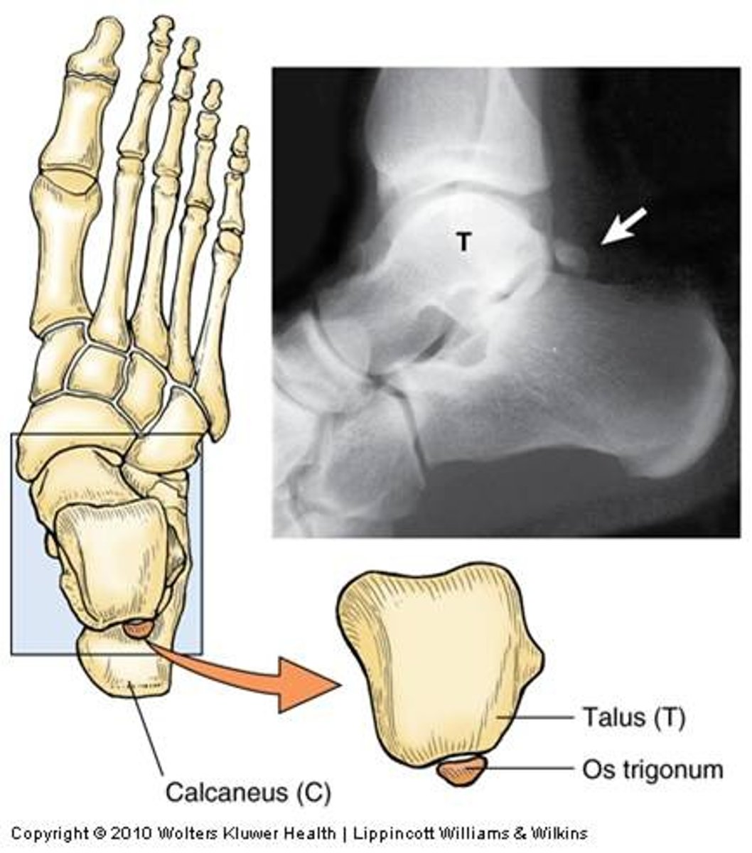 <p>Impingement causing pain in relevé under the Achilles tendon</p>