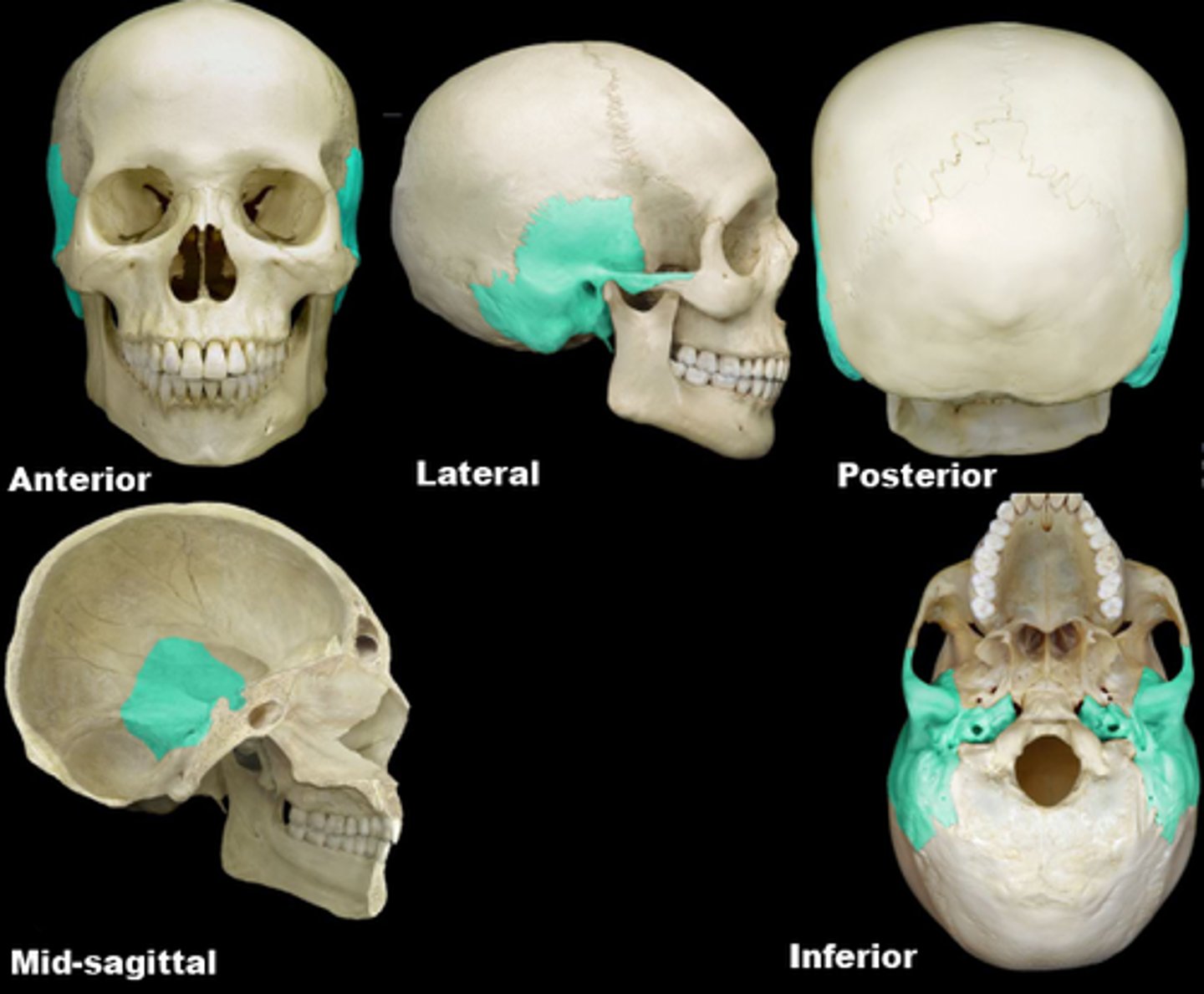 <p>thinnest part of the skull</p>