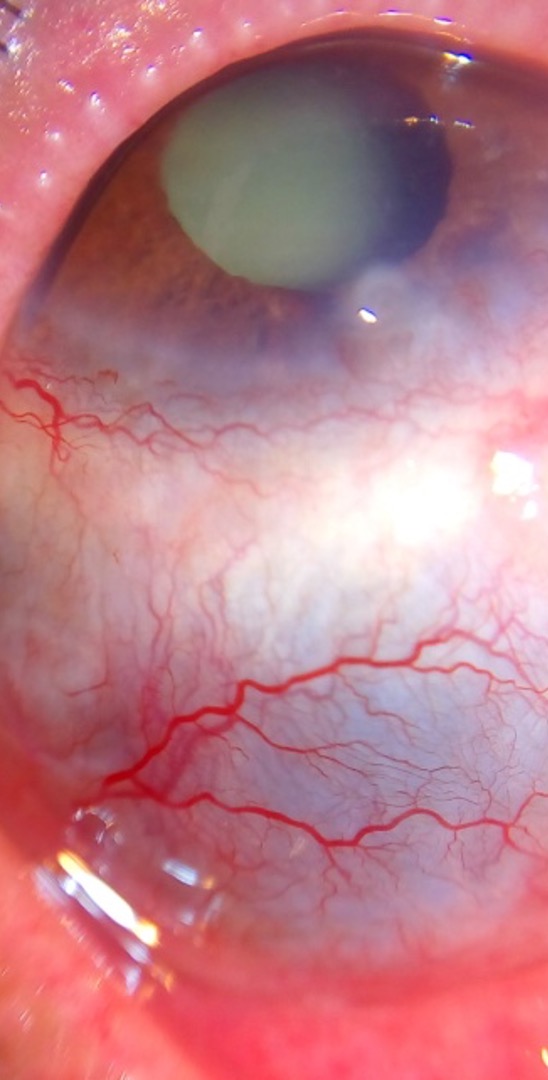 <p>painful, sclera edema</p>