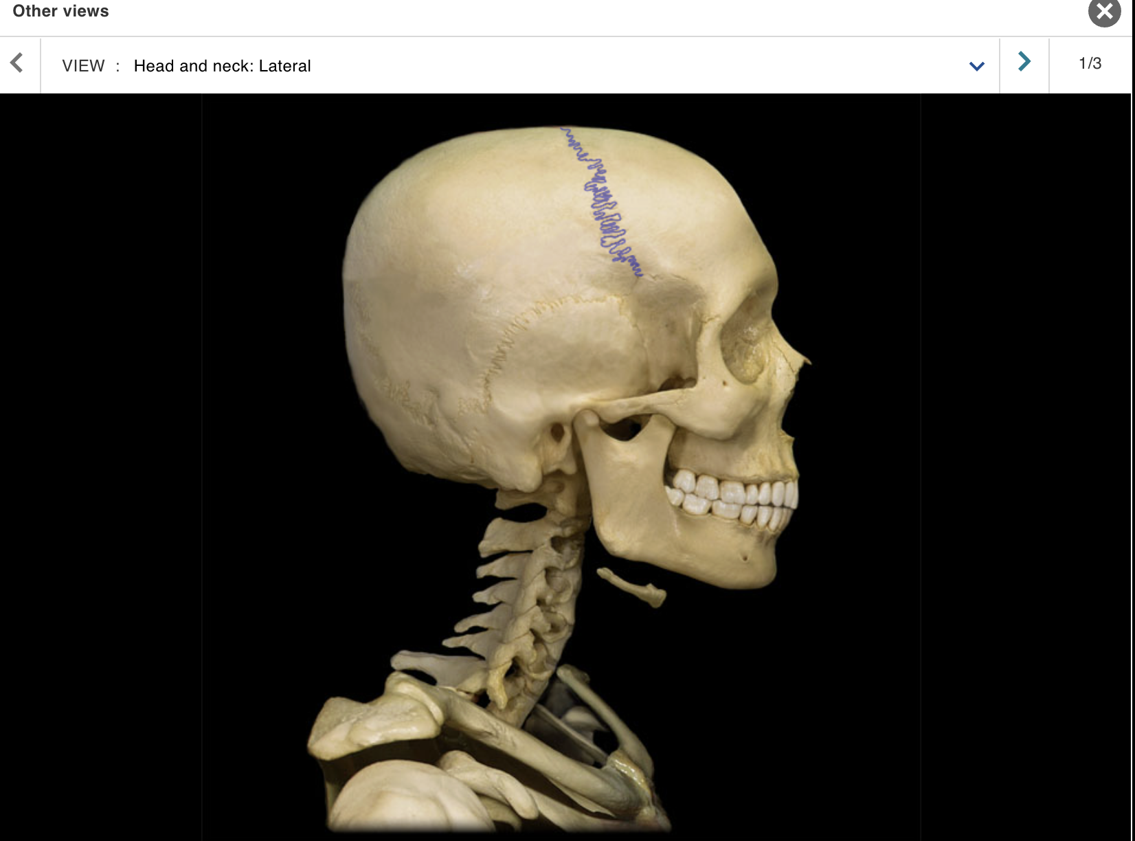 <p>Location:</p><p class="p1">• Skull (superior)</p><p class="p1">Description:</p><p class="p1">• Joint between frontal and parietal bones</p>