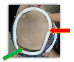 <ul><li><p>slight blanching is observed over areas of total contact where skull growth is unwanted </p></li><li><p>voids are observed over the flattened areas where skull growth is encourage </p></li><li><p>there design modifications promote more symmetrical and/or proportional skull growth </p></li></ul><p></p>