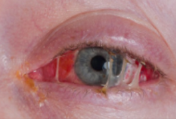 <p>what is blepharitis?</p>