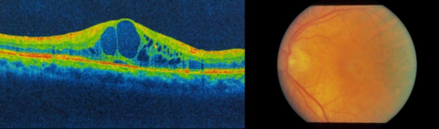 <p>petaloid pattern of fluid-filled intraretinal cysts = petaloid due to Henle's fiber orientation</p>
