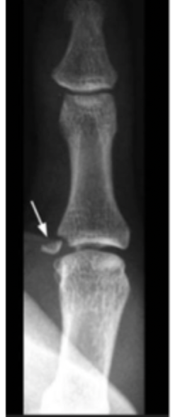 <p>30 y/o male presents to the ED for a hand pain that is exacerbated by grasping things. He states that he caught himself with his hand after falling. On physical exam you not tenderness of the UCL and during a radial ulnar stress exam. X-rays reveal an avulsion fracture. What is your op treatment for grade 3 partial injuries?</p>