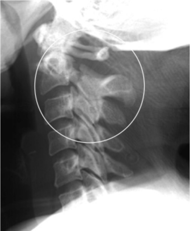 <p>fx of posterior aspects of C2</p><p>hyperextension injury, often w/ spinal cord compromise; subluxation of C2 over C3</p>