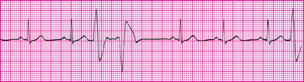 <p>Two PVCs that occur back to back</p>