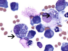 <p>Cytology will show macrophages filled with small yeast with clear halos </p>