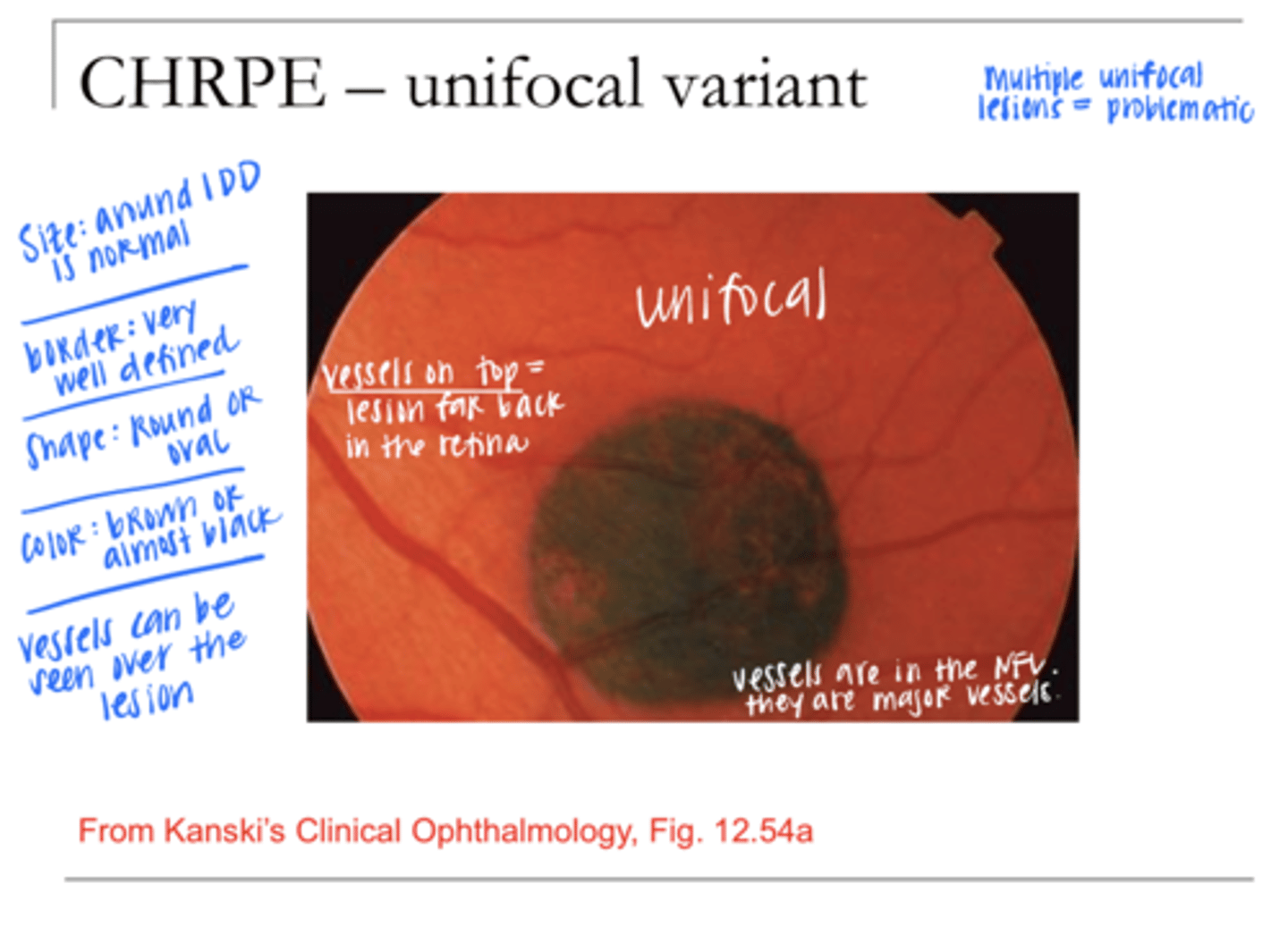 <p>Unifocal CHRPE Location in the Retina</p>