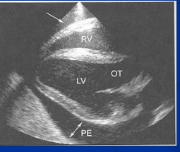 <ul><li><p><span style="color: rgb(136, 136, 136);"><strong>Et: </strong></span><span>Inflam of pericardium, <u>Actinobacillus, Strep zoo,</u><strong><u> influenza</u></strong><u>,</u> EVA, AHS</span></p><ul><li><p><span>Fibrinous or Effusive</span></p></li></ul></li></ul><ul><li><p><span style="color: rgb(136, 136, 136);"><strong>Cs:</strong></span><span> <u>fever, depression</u>, exercise intolerance, <u>weakness,</u> tachycardia, muffled heart sounds, weak pulses, circulatory collapse</span></p></li><li><p><span style="color: rgb(136, 136, 136);"><strong>Dt:</strong></span><span> <strong><u>Echo</u></strong><u> (effusion), Pericardial tap</u>, ECG w/ <u>Low QRS amp</u></span></p></li><li><p><span style="color: rgb(136, 136, 136);"><strong>Tx:</strong></span><span> <u>Pericardial drainage + lavage, Antibiotics, Corticosteroids</u></span></p><ul><li><p><span><u>Prognosis poor&nbsp;</u></span></p></li></ul></li></ul><p></p>
