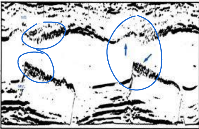 <p>Yes. But DIASTOLIC flutter is ABNORMAL! (Questioning AR)</p>