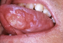 <p>Why is there a delay in seeking care of oral squamous cell carcinoma?</p>