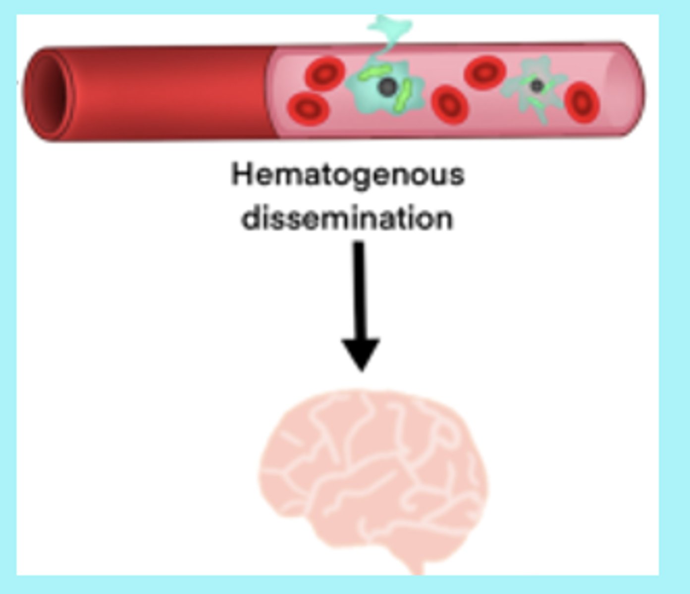 <p>spreading via the bloodstream</p><p>- bacteria attach to the nasopharyngeal epithelium, breach the mucosal barrier, and gain access to the bloodstream</p>