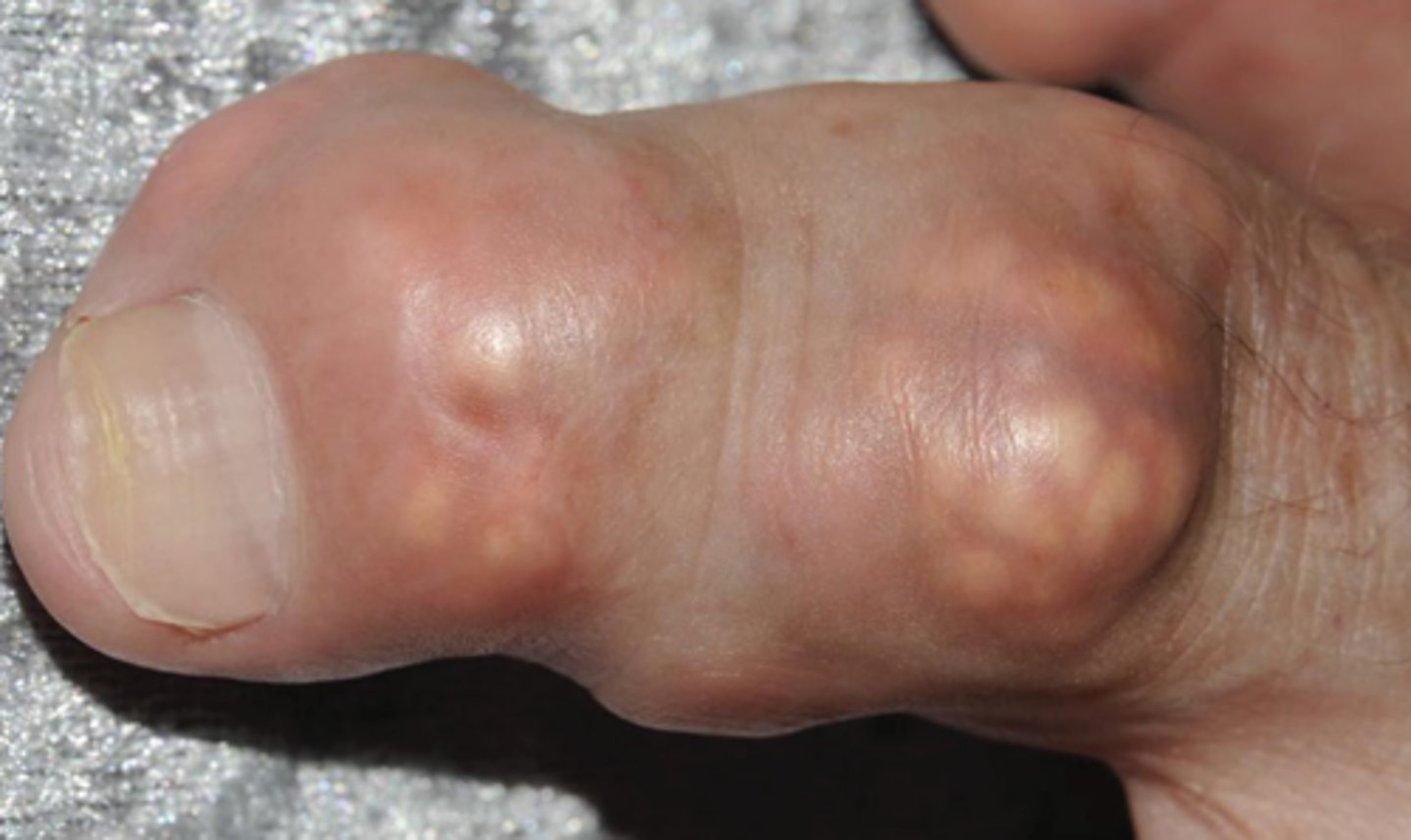 <p>White chalky aggregates of uric acid crystals with fibrosis and giant cell reaction in soft tissues and joints; seen in gout</p>