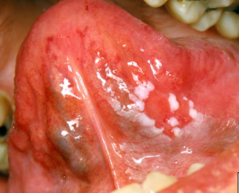 <p>premalignant, red/white patches that show dysplasia on biopsy </p>