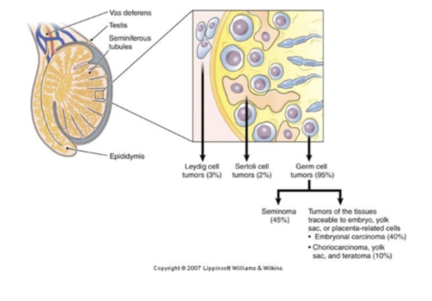 <p>stage 1: tumor confined to testes, epididymis or spermatic cord</p><p>stage 2: tumor spreads to retroperitoneal lymph nodes below the diaphragm</p><p>stage 3: metastases outside the retroperitoneal nodes or above the diaphragm</p>