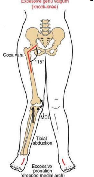 <p>increased shear force across the femoral neck, adducted hip, valgus knee, pronation at foot, shorter limb </p>