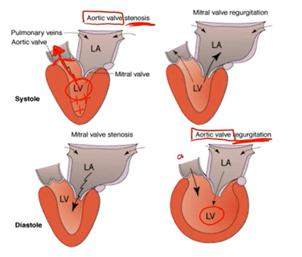 <p>Stenosis: valve does not open all the way; harder to force blood out → narrow</p><p></p><p>Regurgitation: valve does not close all the way → leaks&nbsp;</p>