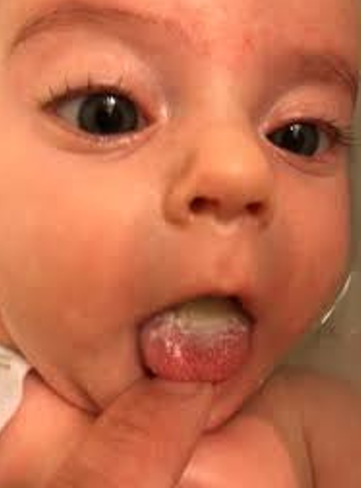 <ul><li><p><strong>Fungal Infection</strong></p></li><li><p><strong>Sources:</strong></p><ul><li><p>Breastfeeding infant</p></li><li><p>Corticosteroids</p></li><li><p>Antibiotics</p></li><li><p>Immunocompromised</p></li></ul></li><li><p><strong>Treatment:</strong></p><ul><li><p><em>Nystatin</em> or <em>Clotrimazole</em> (for adults)</p></li></ul></li><li><p><strong>Nursing Care:</strong></p><ul><li><p>Apply medication with a swab or use "swish and swallow" technique.</p></li><li><p>Sterilize bottles, nipples, pacifiers, etc.</p></li></ul></li></ul><p></p>