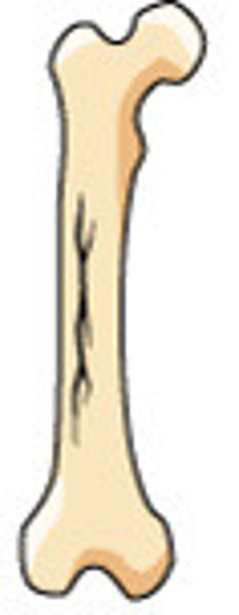 <p>(= a thin broken line in the bone): Gãy xương nhỏ</p><p>Synonyms: Small fracture, minor break</p><p>Example: The X-ray showed a hairline fracture in his ankle</p>