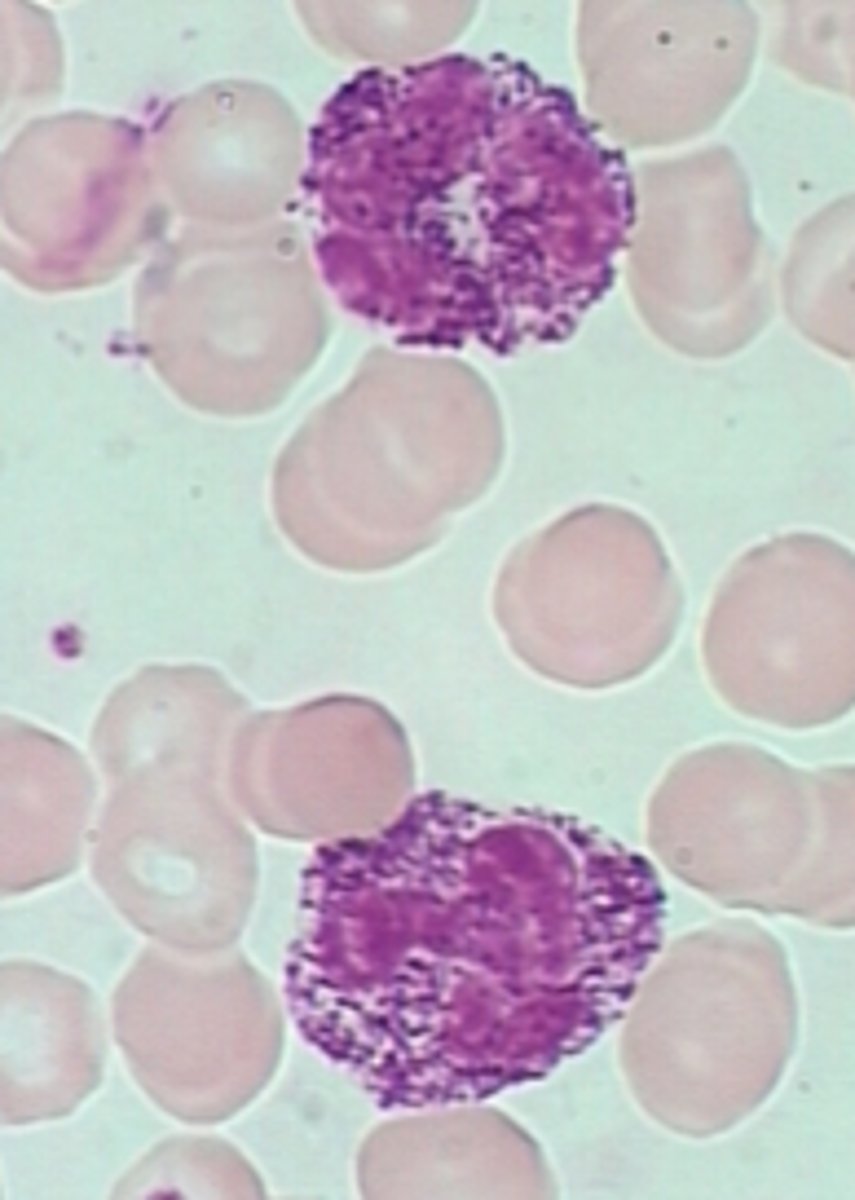 <p><span style="text-decoration:underline">ID this Abnormality</span>:</p><p><strong><em><span class="bgY">Lysosomal stoarge disease from deficiencies of lysosomal enzymes &amp; other essential proteins</span></em></strong></p><p>-<span style="text-decoration:underline">Dx</span>:</p><p>&gt; <span style="text-decoration:underline">WBCs</span> = Increased Granulations &amp; Inclusions</p><p>&gt; <span style="text-decoration:underline">Neutrophils</span> = Extreme Toxic Granulation</p><p>&gt; Accumulation of undigested substrates (<strong><em>mucopolysaccharides, glycosphingolipids, glycoproteins</em></strong>) d/t <strong><em>enzyme deficiencies</em></strong></p>