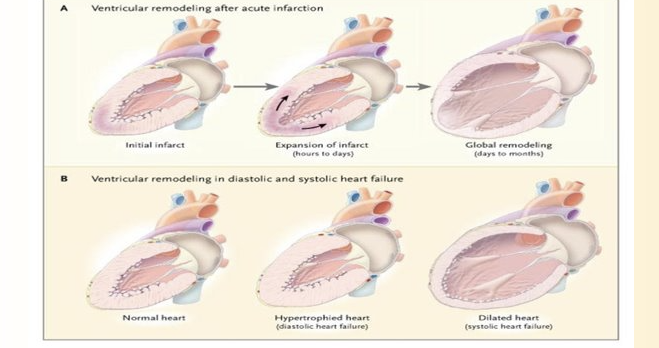 <ul><li><p>Heart becomes hypertrophic due to increased demands</p></li><li><p>Then decreased imated ???due to systolic heart failure</p></li></ul><p></p>