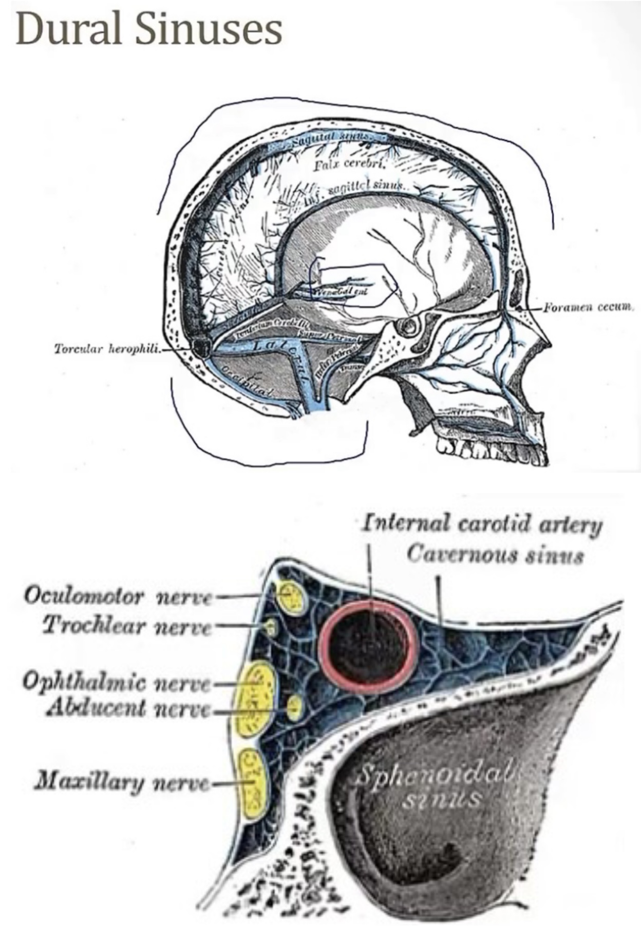 <p>-cerebral veins; arachnoid granulations</p><p>-internal jugular vein</p><p>-2; eyes and cortex; internal jugular vein; 3, 4, 5(1), 5(2), and 6; internal carotid</p><p>-infection; septic thrombus; carotid; rupturing; Horner’s syndrome, swollen eyes, and a headache</p>